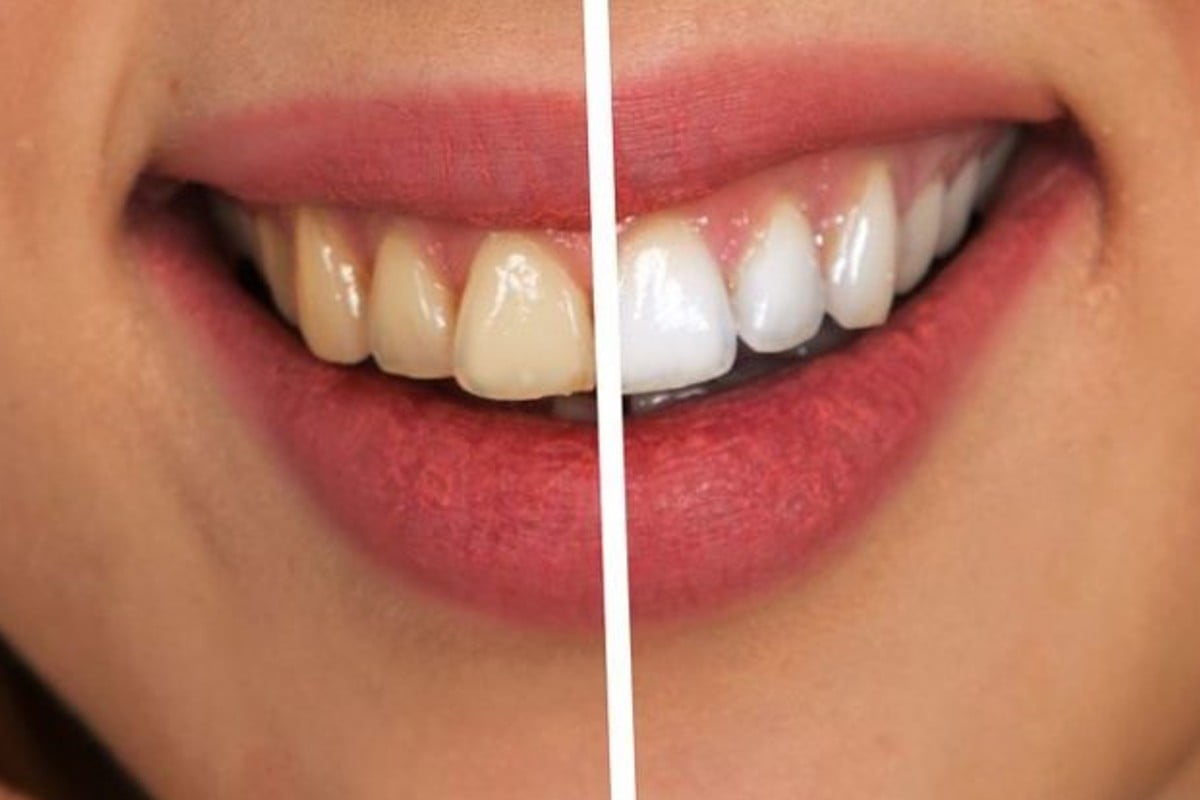denti bianchissimi ecco 5 rimedi rimedi per denti bianchi