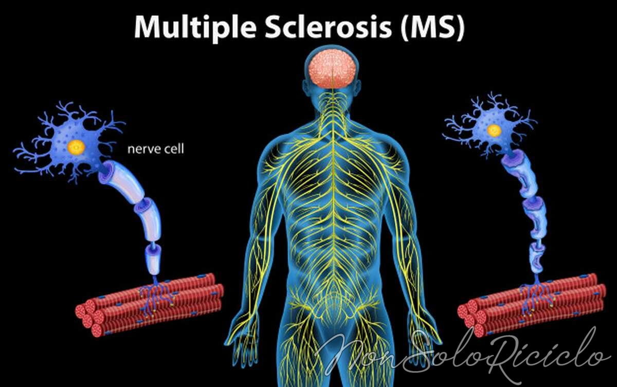 sclerosi multipla