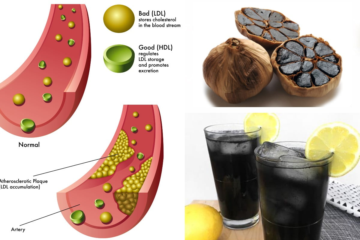 El ajo negro reduce el colesterol Ajo negro
